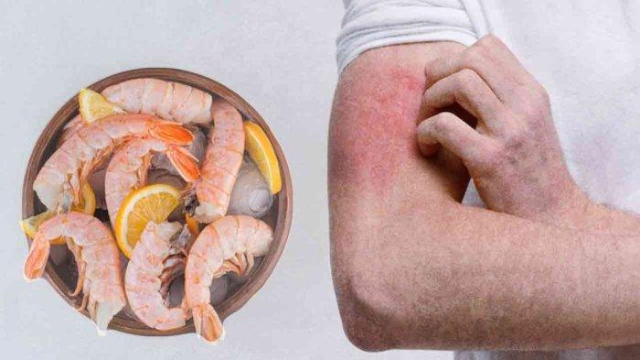 Gejala Umum dari Adanya Tanda Alergi Udang