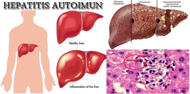 Inilah Jenis Penyakit yang Sering Menggangu Organ Hati